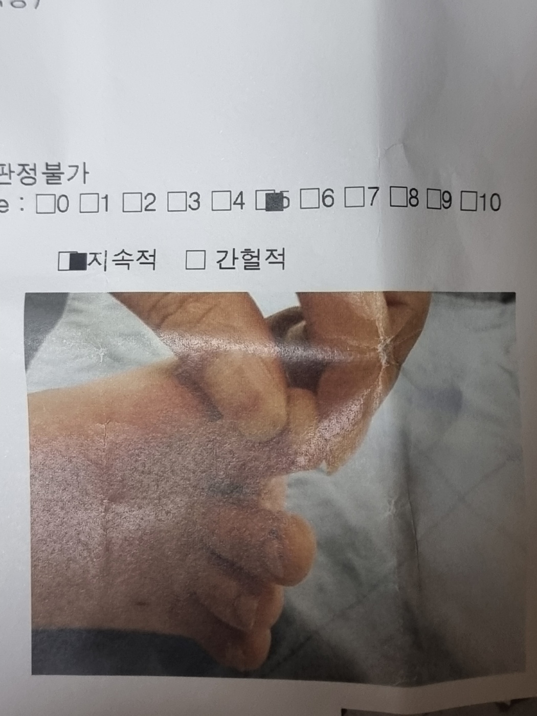 A shocking photo of a severely inflamed and swollen foot, indicative of a serious infection.