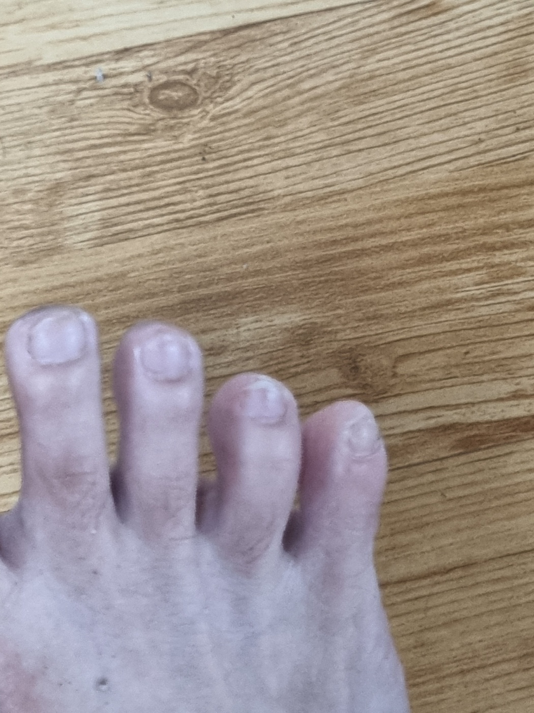 A present-day photo of the user's foot, now healthy and intact, a symbol of recovery.